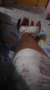Avinash's hand injured in accident